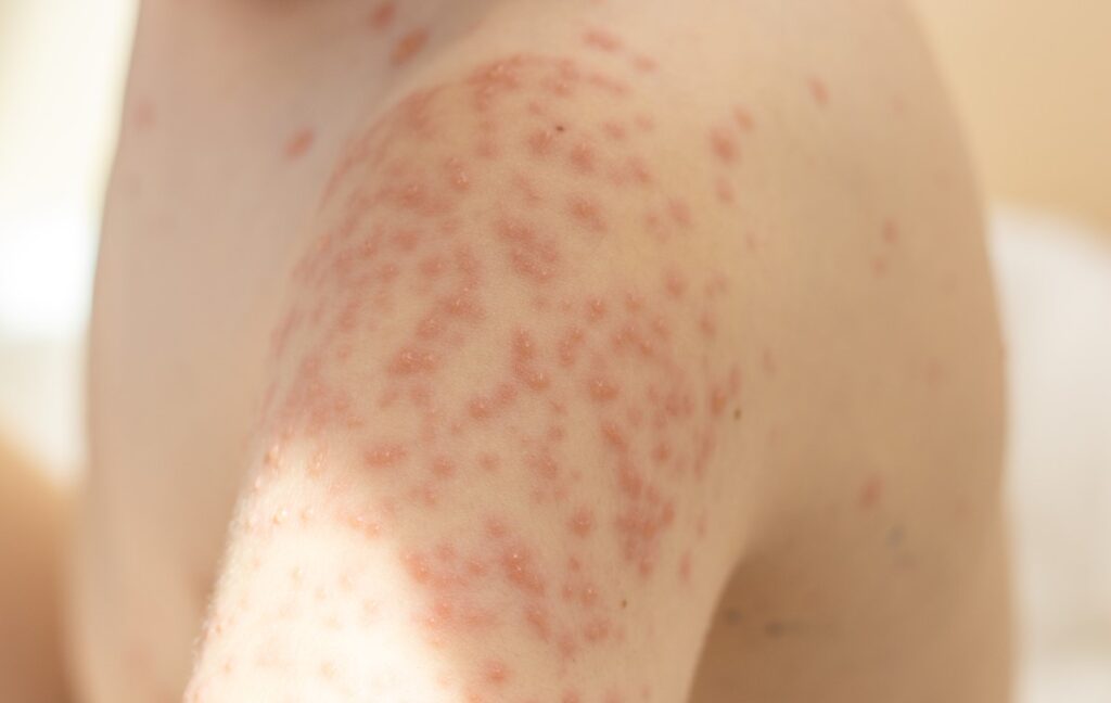 Chicken Pox in Children: Understanding the Symptoms, Treatment, and Prevention